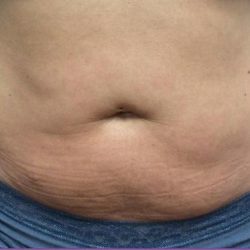 TruSculpt ID Before & After Patient #1566